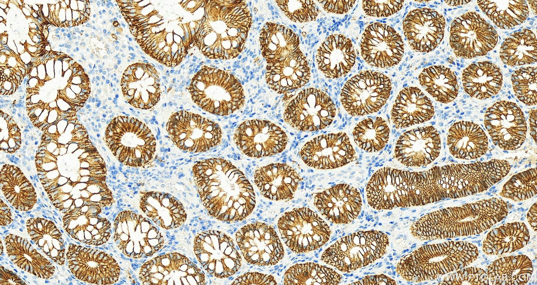 Immunohistochemistry (IHC) staining of human colon cancer tissue using Cadherin-17 Monoclonal antibody (60351-1-Ig)