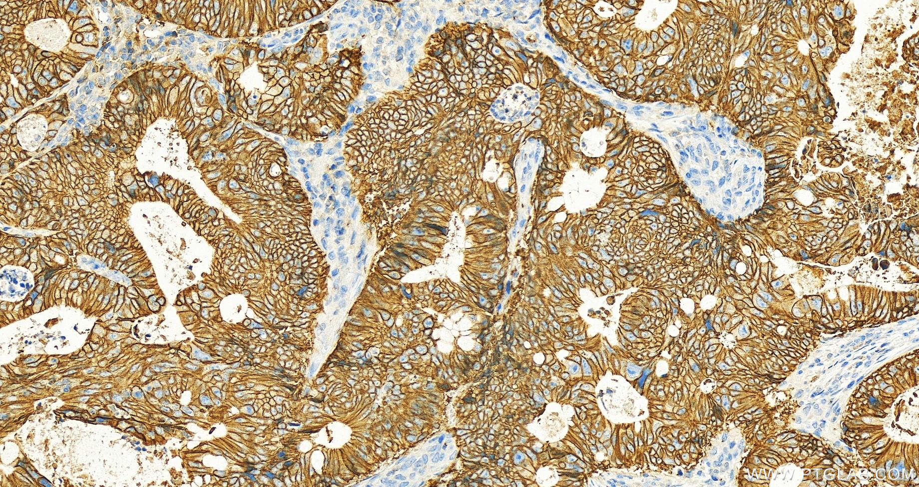 Immunohistochemistry (IHC) staining of human colon cancer tissue using Cadherin-17 Monoclonal antibody (60351-1-Ig)