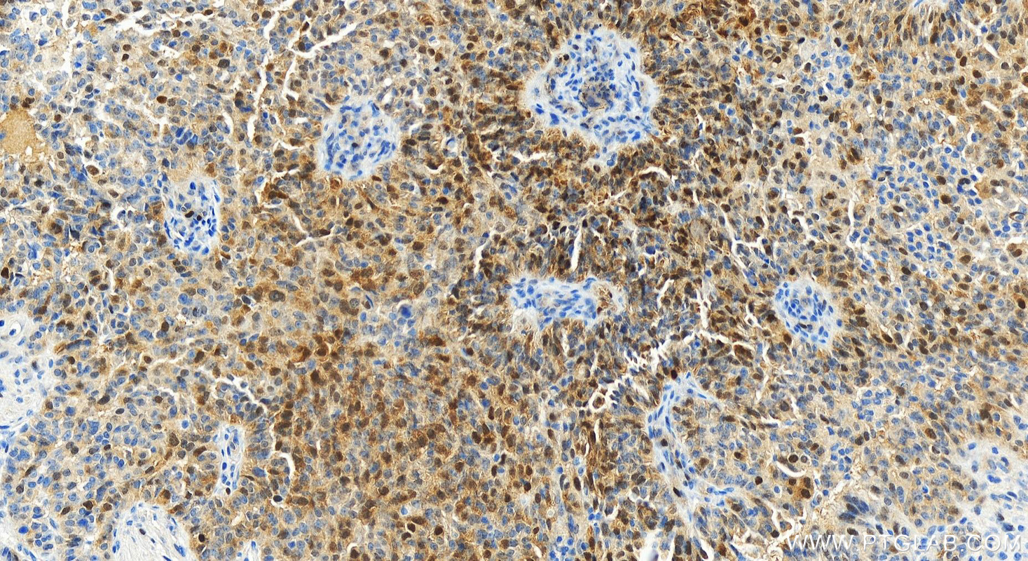 Immunohistochemistry (IHC) staining of human ovarian  cancer using CDK2 Recombinant antibody (83635-2-RR)