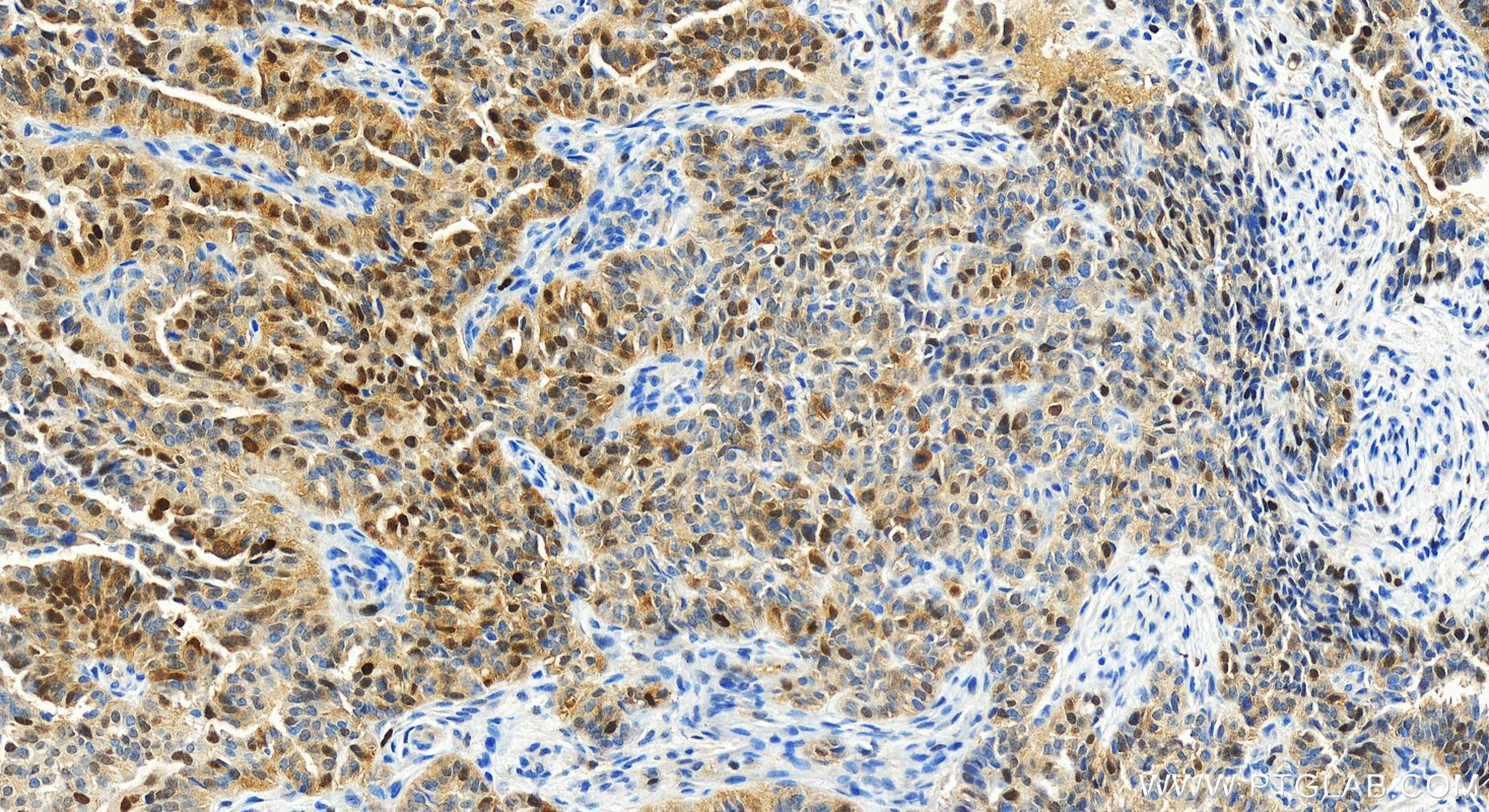 Immunohistochemistry (IHC) staining of human ovarian  cancer using CDK2 Recombinant antibody (83635-2-RR)