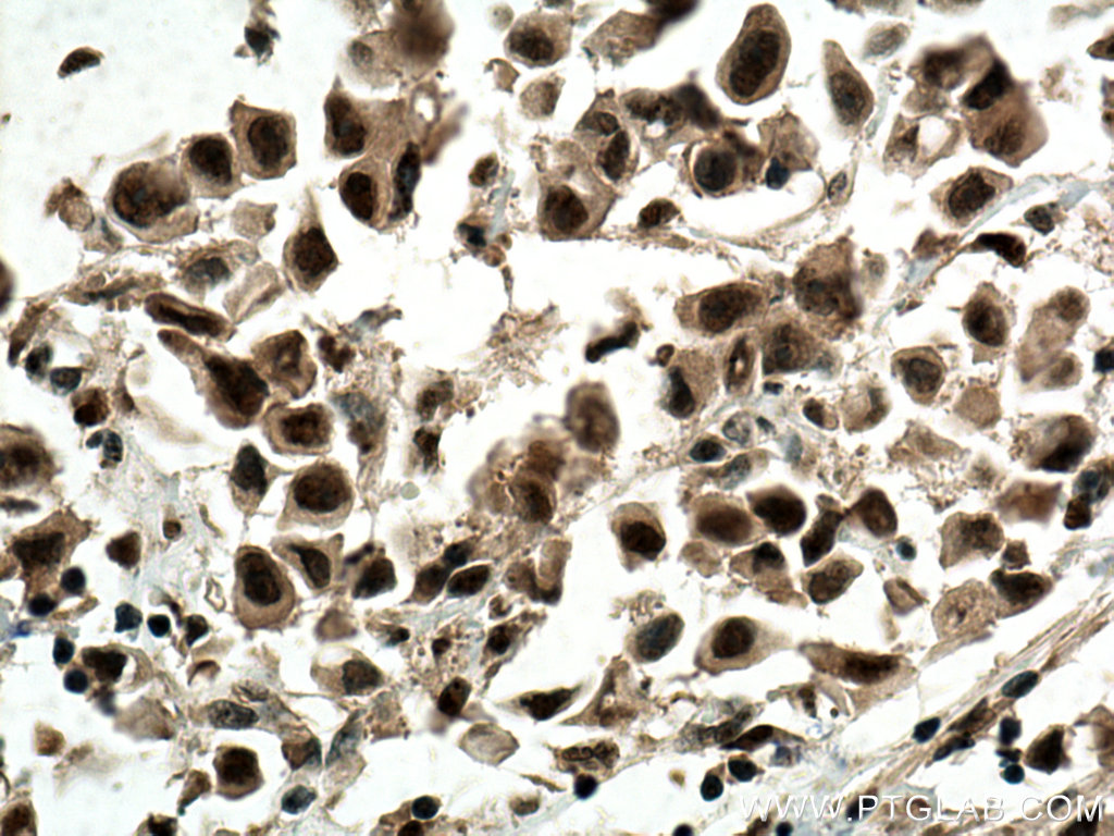Immunohistochemistry (IHC) staining of human breast cancer tissue using CDK4 Monoclonal antibody (66950-1-Ig)
