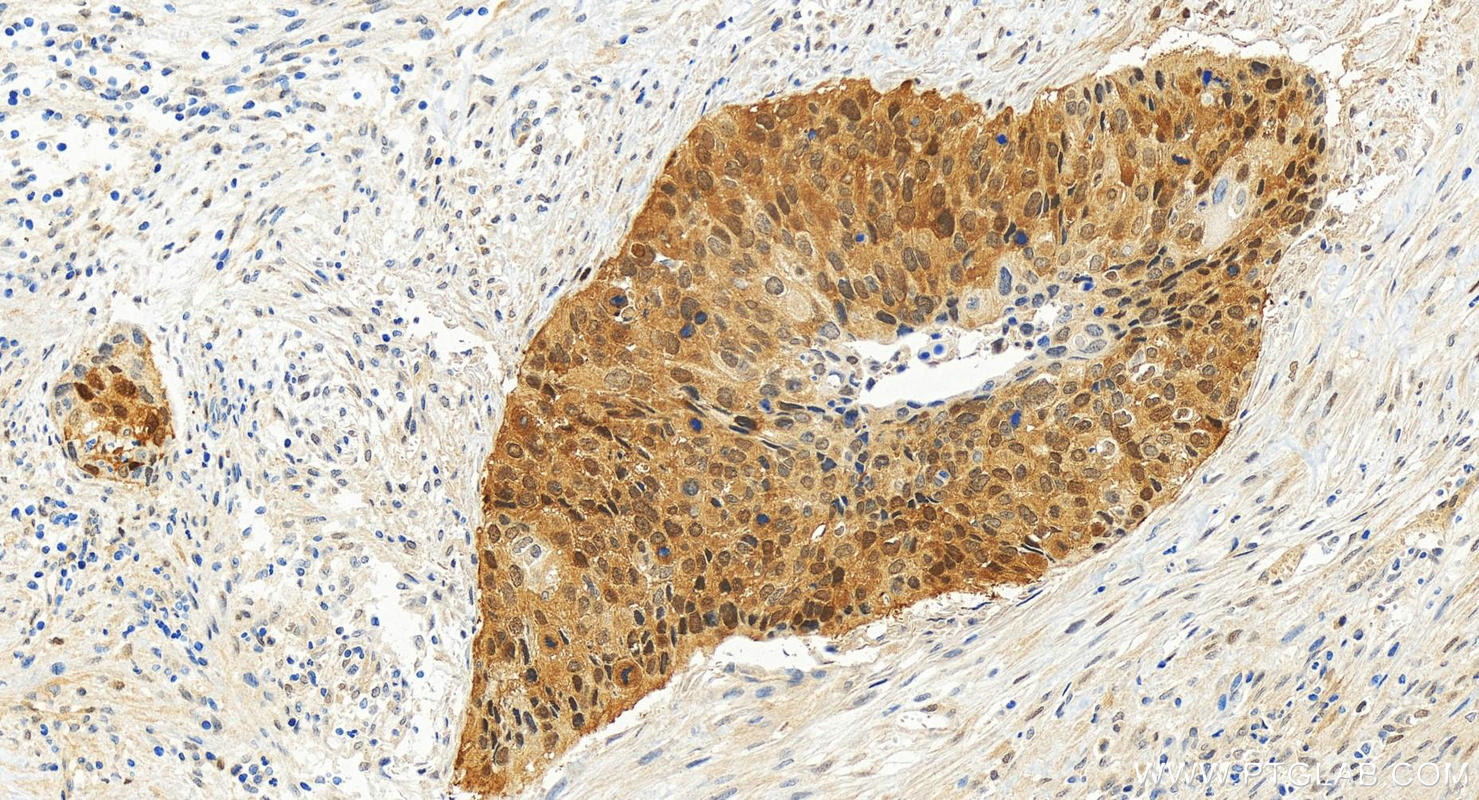 Immunohistochemistry (IHC) staining of human cervical squamous cancer tissue using CDK4 Recombinant antibody (83994-3-RR)