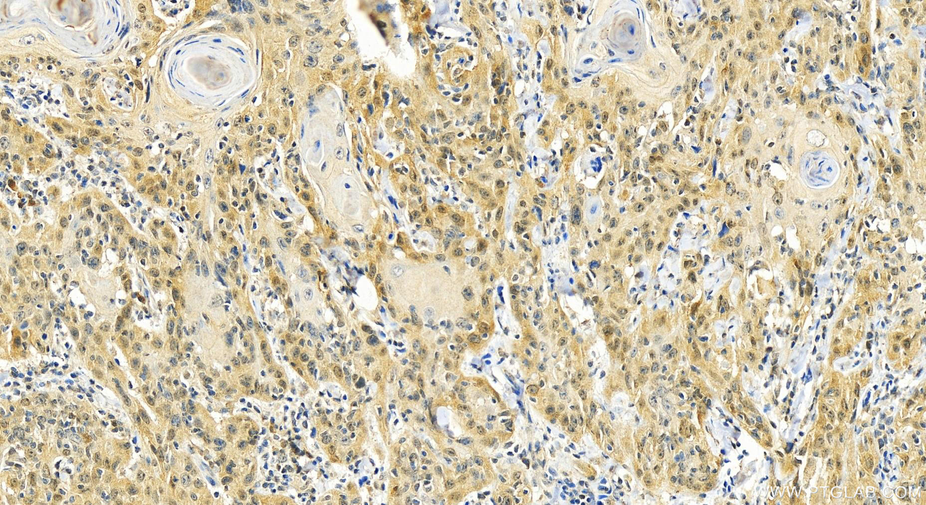 Immunohistochemistry (IHC) staining of human skin cancer tissue using CDK6 Monoclonal antibody (66278-1-Ig)