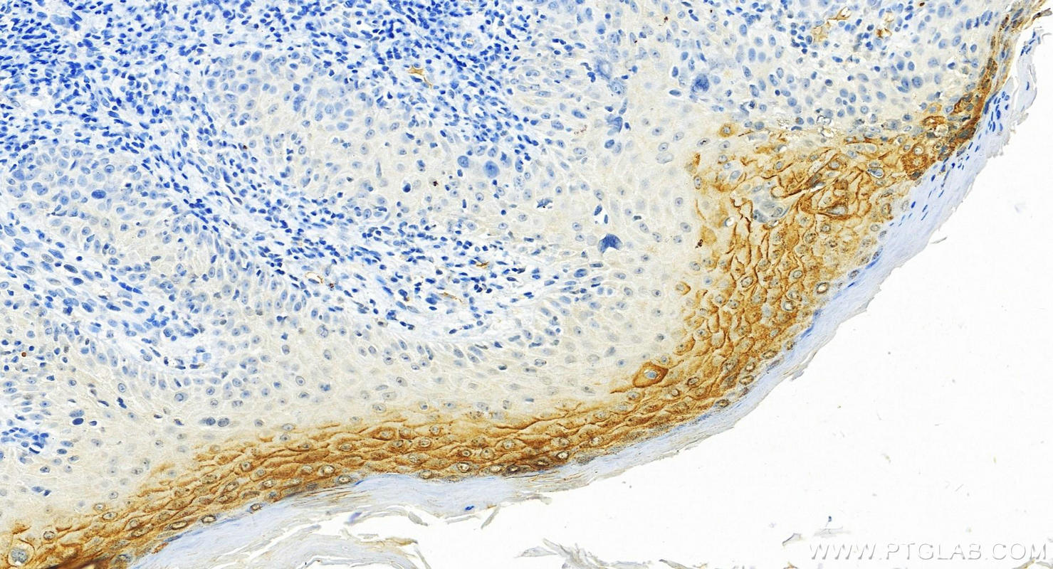 Immunohistochemistry (IHC) staining of human brown disease using CDSN Polyclonal antibody (27953-1-AP)