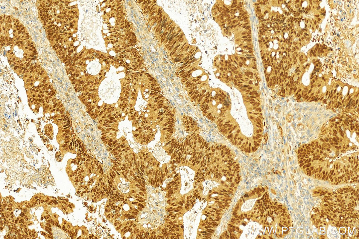 Immunohistochemistry (IHC) staining of human colon cancer tissue using CDX1 Polyclonal antibody (21655-1-AP)