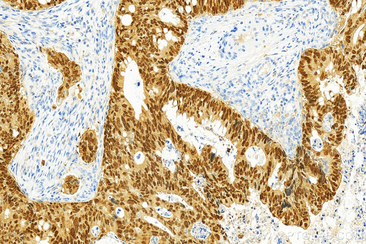 Immunohistochemistry (IHC) staining of human colon cancer tissue using CDX2 Polyclonal antibody (30380-1-AP)