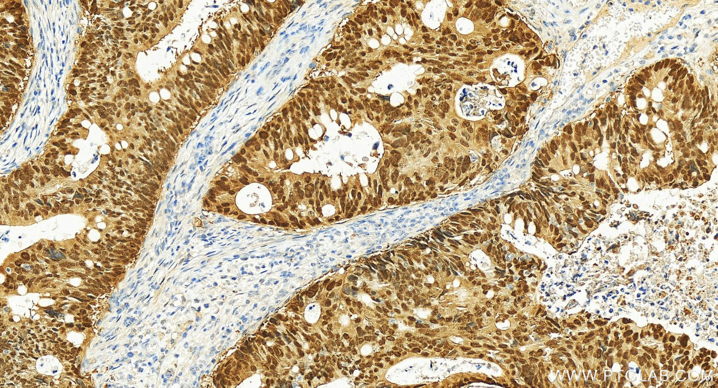 Immunohistochemistry (IHC) staining of human colon cancer tissue using CDX2 Recombinant antibody (82659-1-RR)