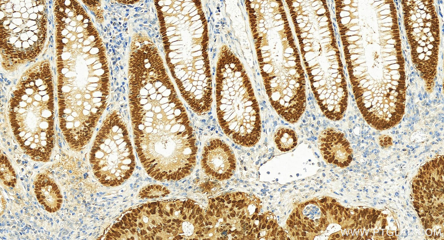 Immunohistochemistry (IHC) staining of human colon cancer tissue using CDX2 Recombinant antibody (82659-1-RR)