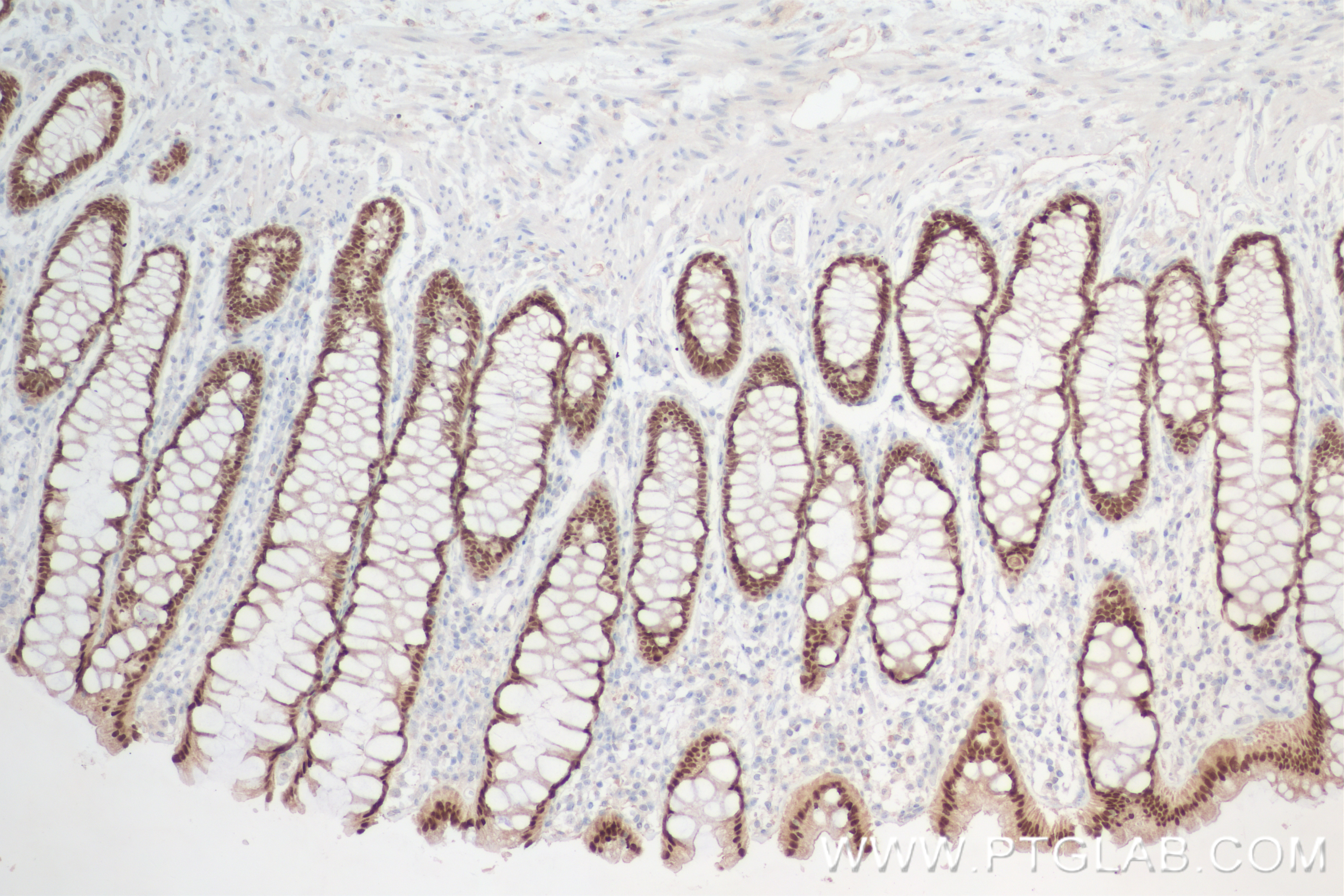 Immunohistochemistry (IHC) staining of human rectal cancer tissue using CDX2 Recombinant antibody (82659-1-RR)