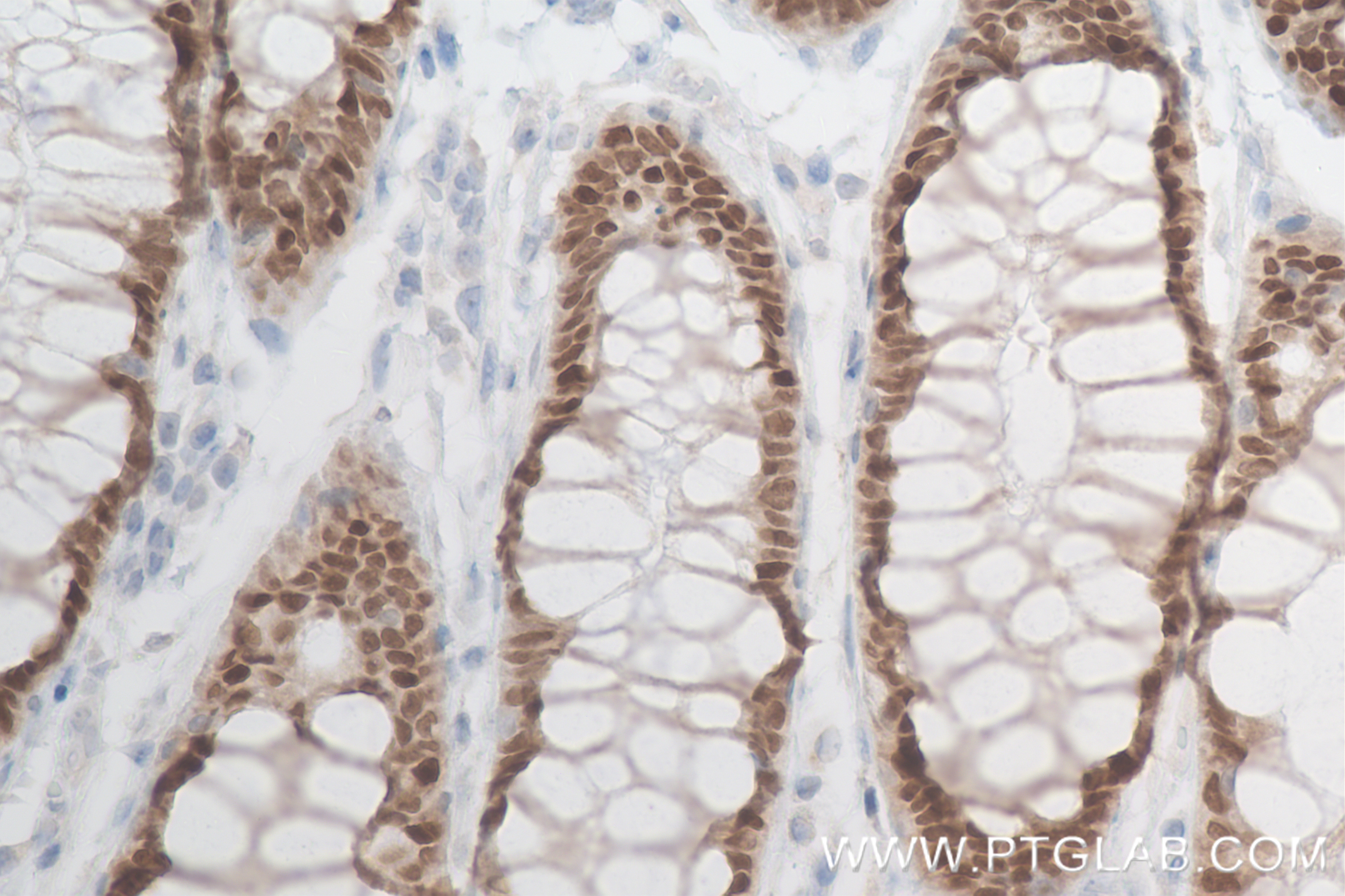 Immunohistochemistry (IHC) staining of human rectal cancer tissue using CDX2 Recombinant antibody (82659-1-RR)