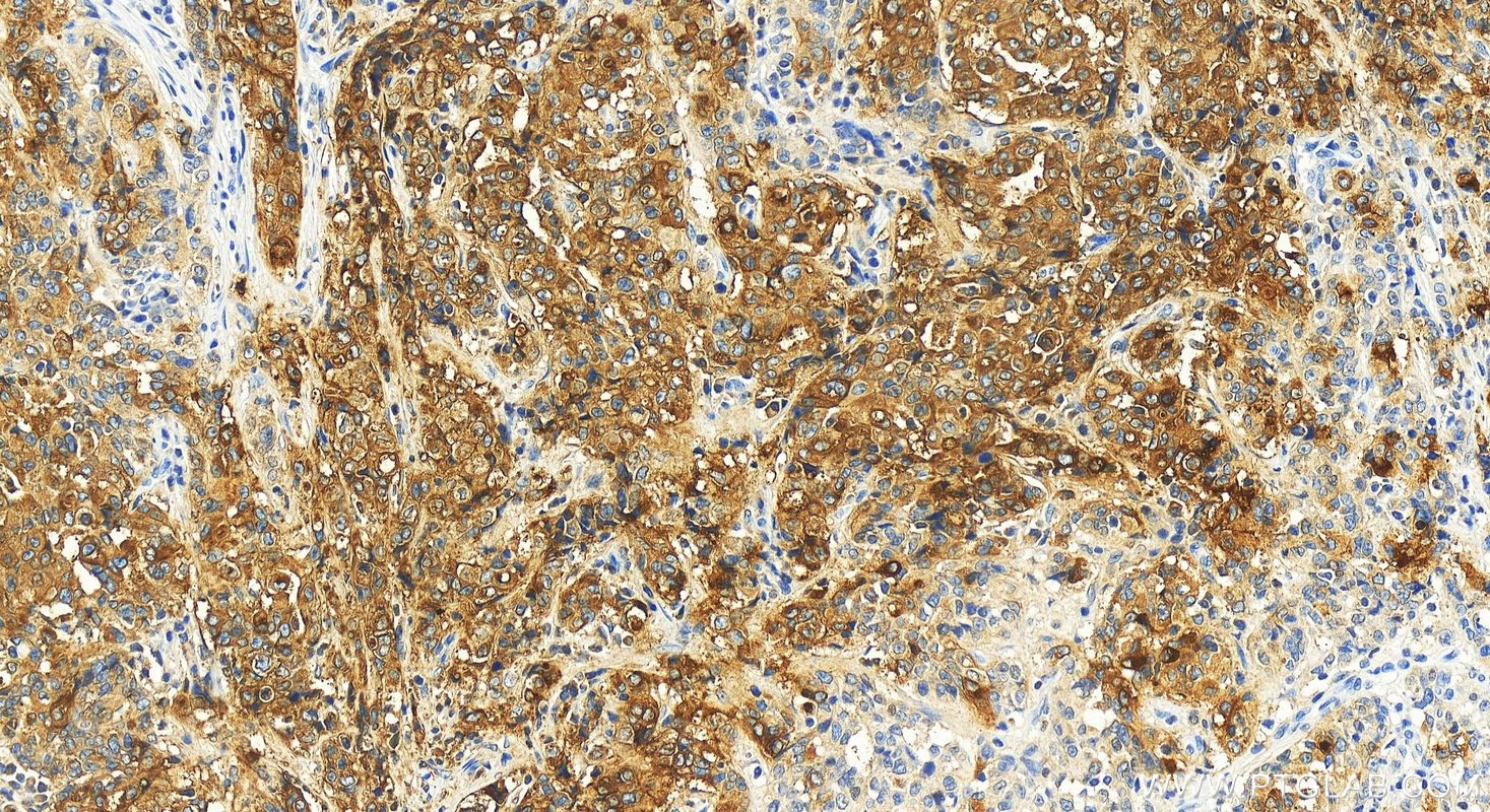 Immunohistochemistry (IHC) staining of human stomach cancer tissue using CEA/CD66e Monoclonal antibody (68377-1-Ig)