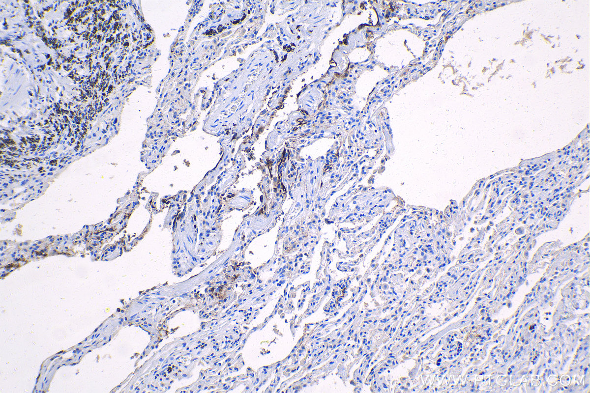 Immunohistochemistry (IHC) staining of human lung tissue using CEA/CD66e Monoclonal antibody (68377-1-Ig)