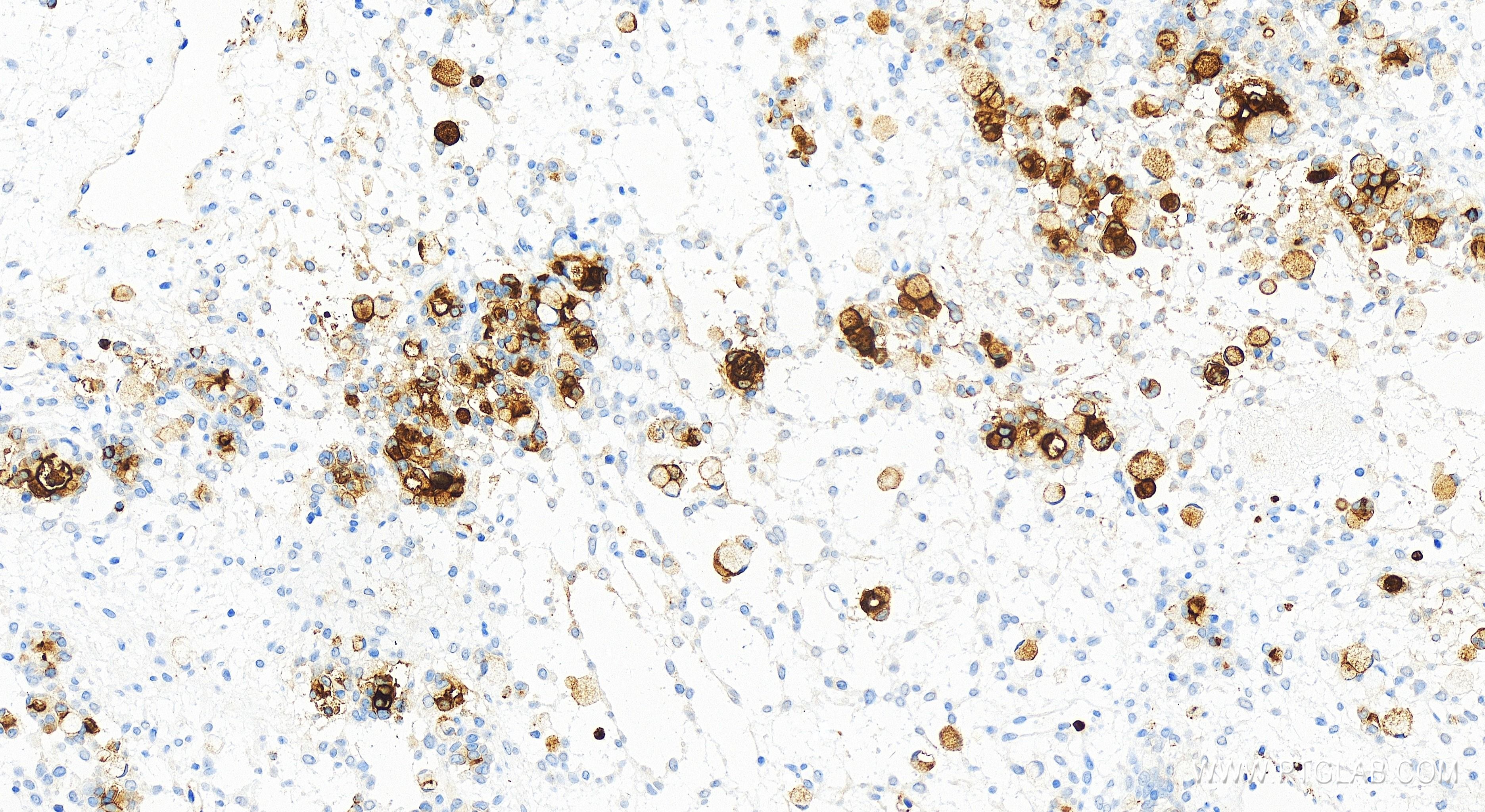 Immunohistochemistry (IHC) staining of human ovary cancer tissue using CEA Recombinant antibody (83653-5-RR)