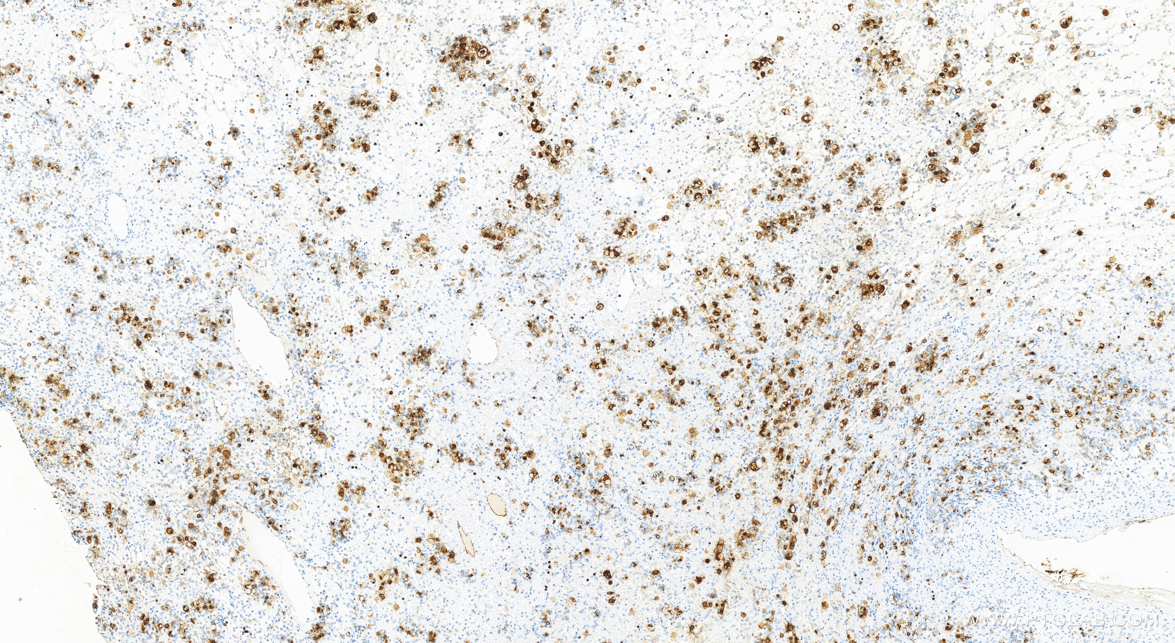 Immunohistochemistry (IHC) staining of human ovary cancer tissue using CEA Recombinant antibody (83653-5-RR)