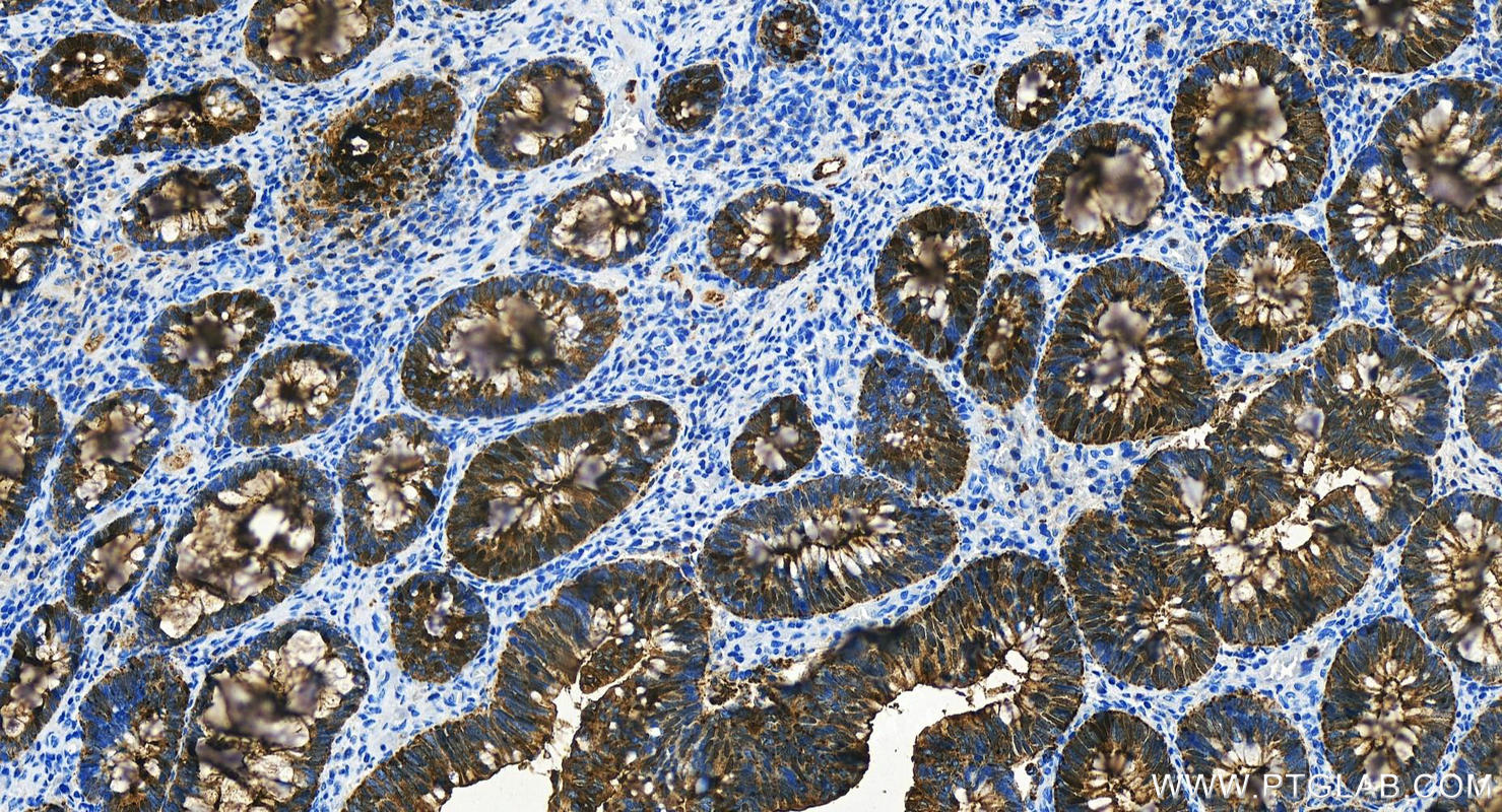 Immunohistochemistry (IHC) staining of human colon cancer tissue using CEA/CD66e Polyclonal antibody (31519-1-AP)