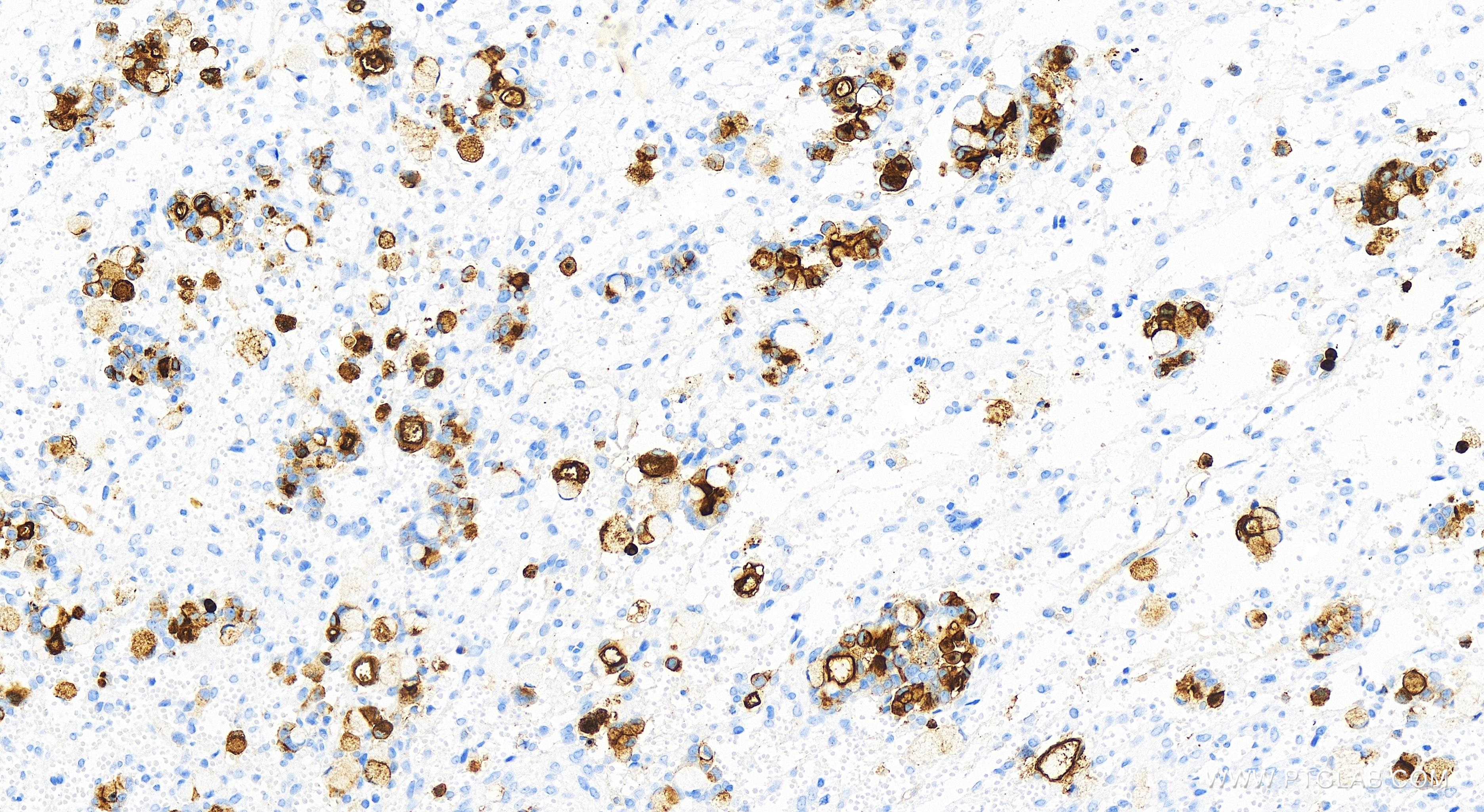 Immunohistochemistry (IHC) staining of human ovary cancer tissue using CEACAM1/CD66a Recombinant antibody (83524-3-RR)