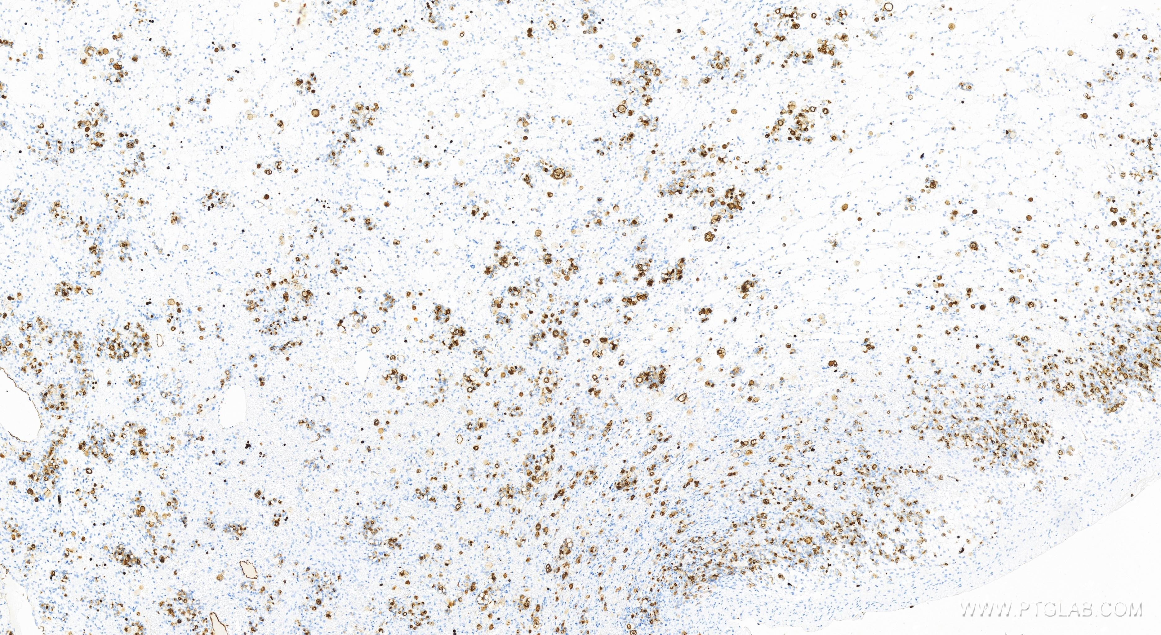 Immunohistochemistry (IHC) staining of human ovary cancer tissue using CEACAM1/CD66a Recombinant antibody (83524-3-RR)