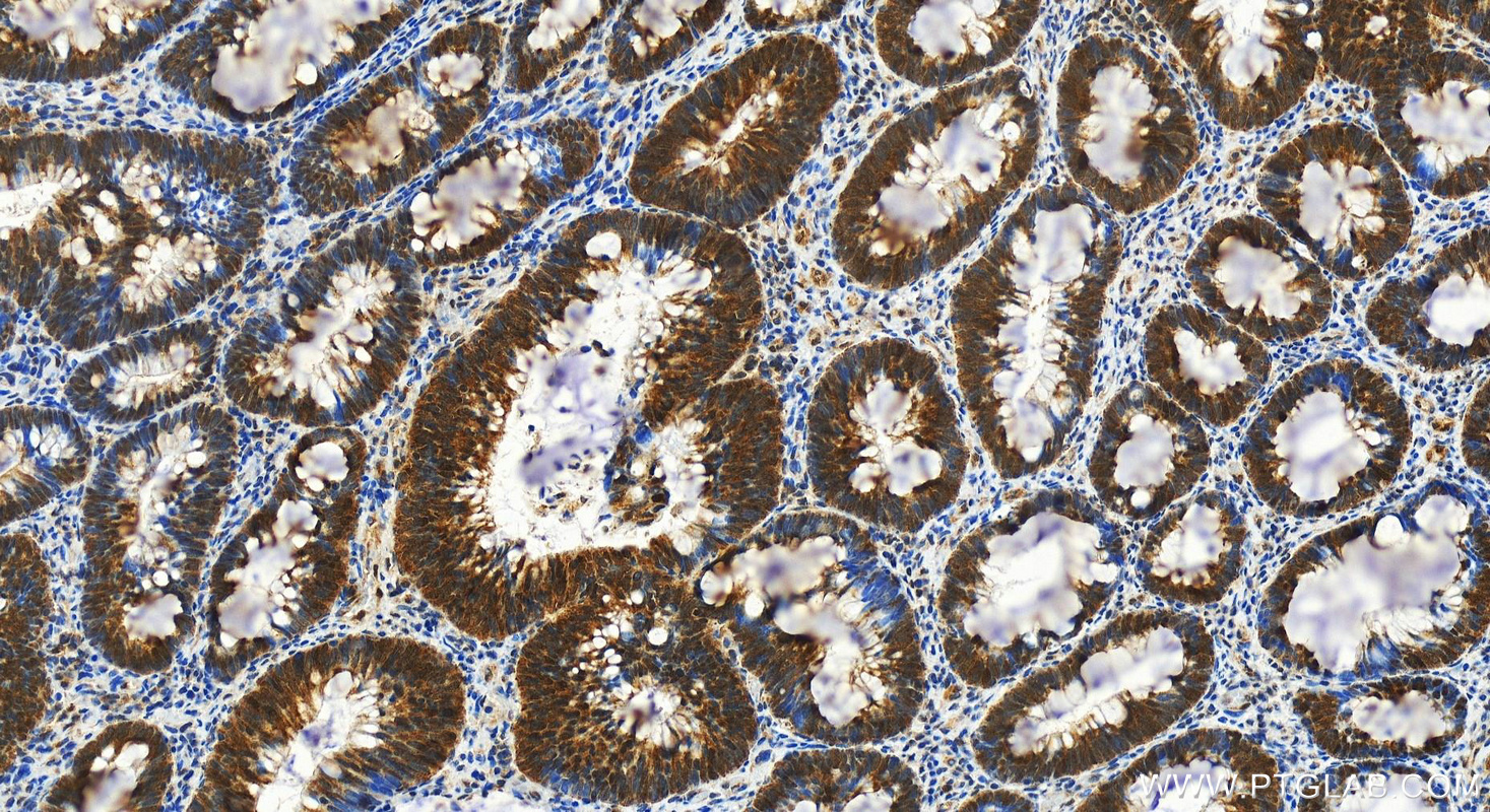 Immunohistochemistry (IHC) staining of human colon cancer tissue using CEACAM3-Specific Polyclonal antibody (19496-1-AP)