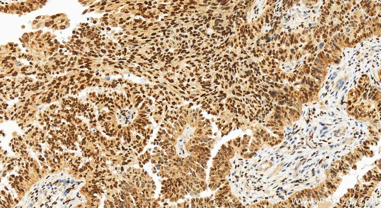 Immunohistochemistry (IHC) staining of human ovarian  cancer using CEBPB Recombinant antibody (83791-6-RR)