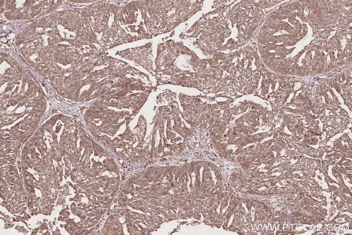 Immunohistochemistry (IHC) staining of human ovary cancer tissue using CEP192 Polyclonal antibody (28700-1-AP)