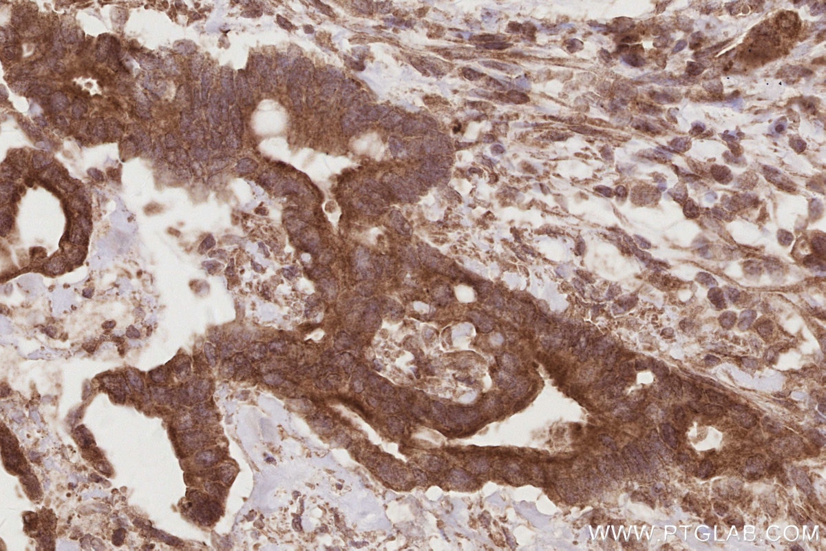 Immunohistochemistry (IHC) staining of human rectal cancer tissue using CEP250/CNAP1 Monoclonal antibody (66814-1-Ig)