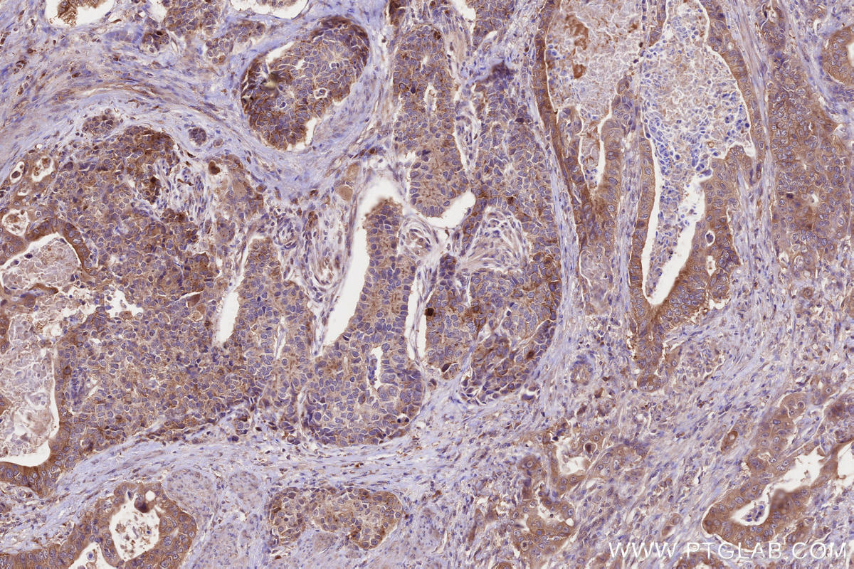 Immunohistochemistry (IHC) staining of human stomach cancer tissue using CEP97 Polyclonal antibody (22050-1-AP)