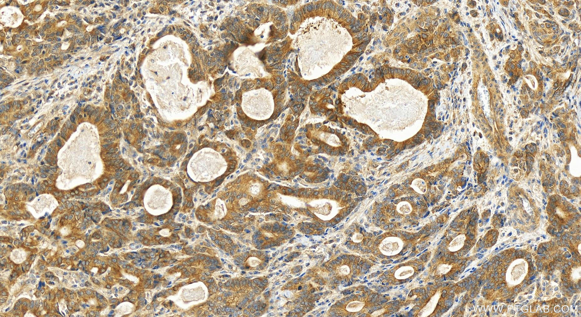 Immunohistochemistry (IHC) staining of human stomach cancer tissue using CES3 Polyclonal antibody (14587-1-AP)