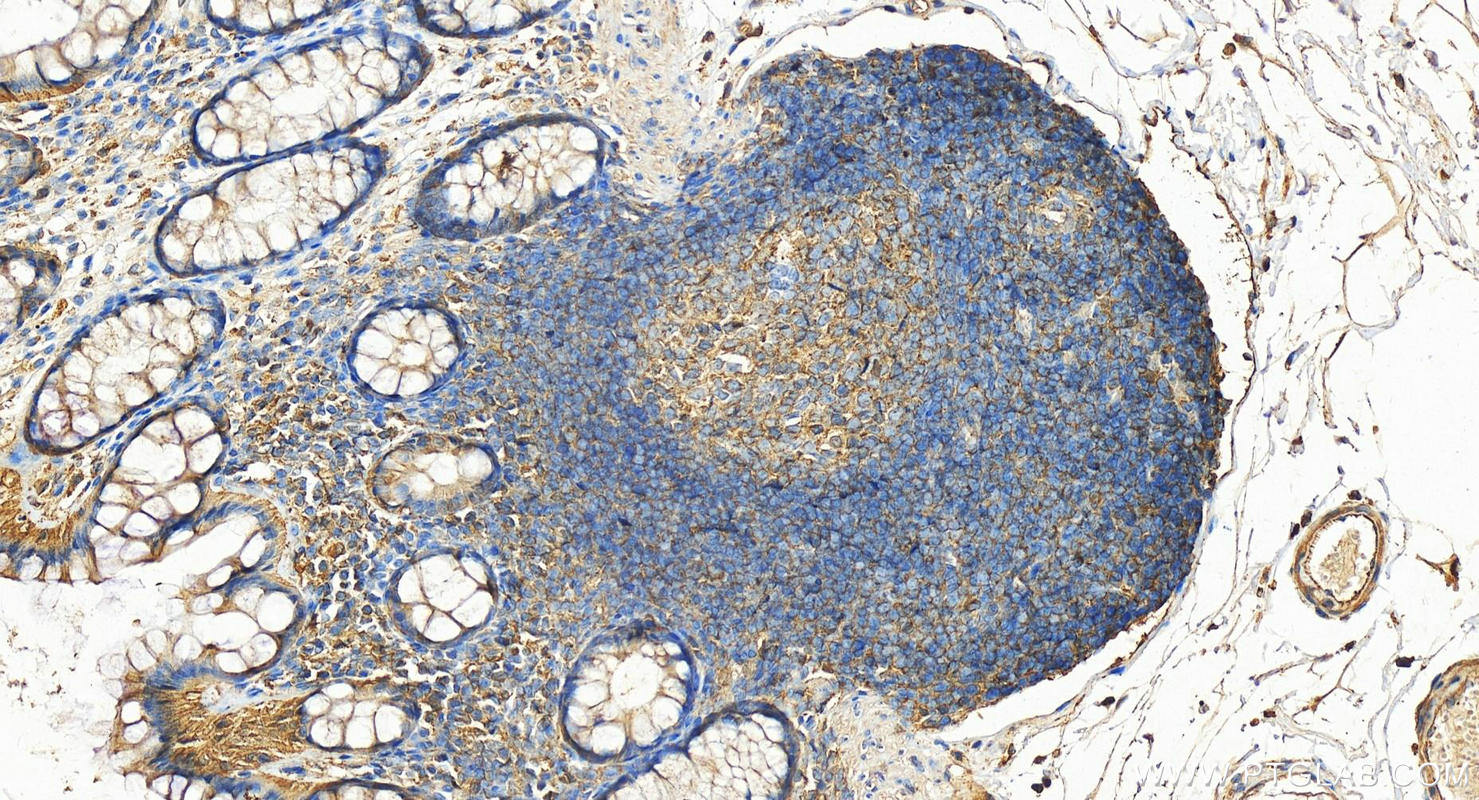 Immunohistochemistry (IHC) staining of human colon tissue using Cofilin Polyclonal antibody (10960-1-AP)