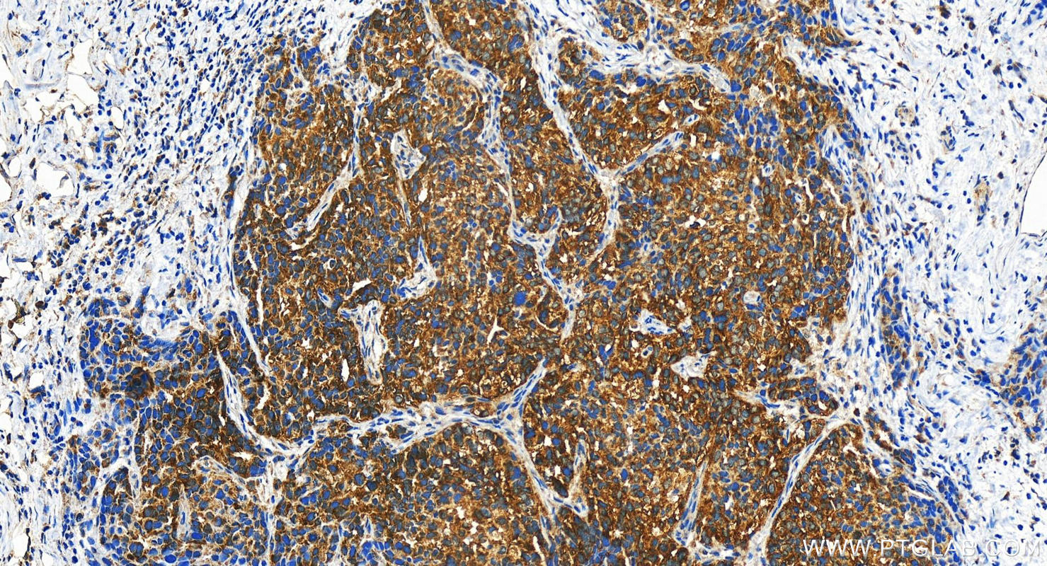 Immunohistochemistry (IHC) staining of human ovary cancer tissue using Cingulin Polyclonal antibody (21369-1-AP)