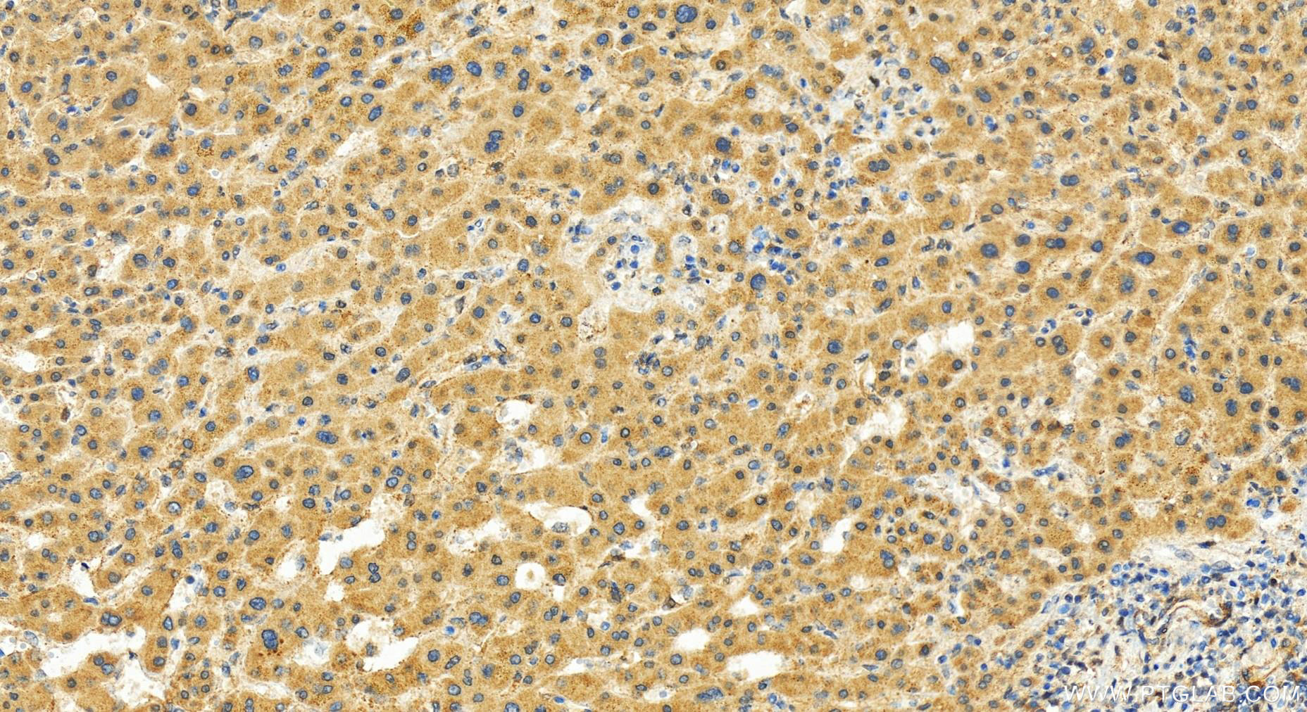 Immunohistochemistry (IHC) staining of human intrahepatic cholangiocarcinoma tissue using CHAF1B Polyclonal antibody (27633-1-AP)