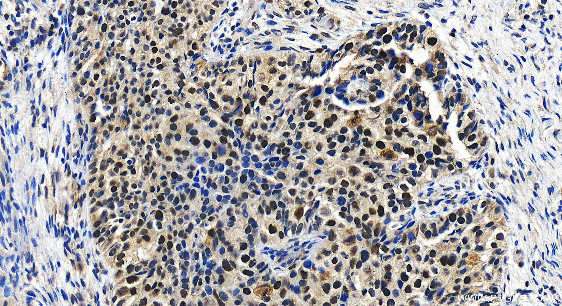 Immunohistochemistry (IHC) staining of human ovary cancer tissue using CHAF1B Polyclonal antibody (27633-1-AP)