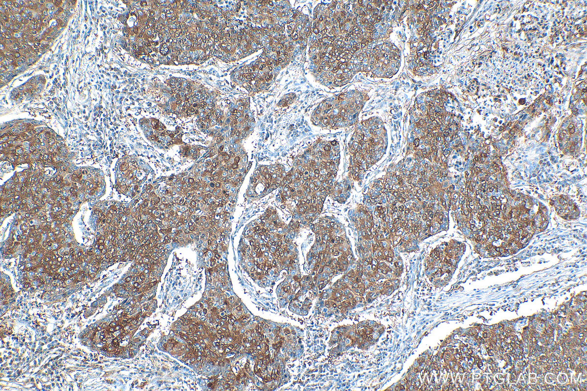 Immunohistochemistry (IHC) staining of human lung cancer tissue using CHAT Polyclonal antibody (20747-1-AP)
