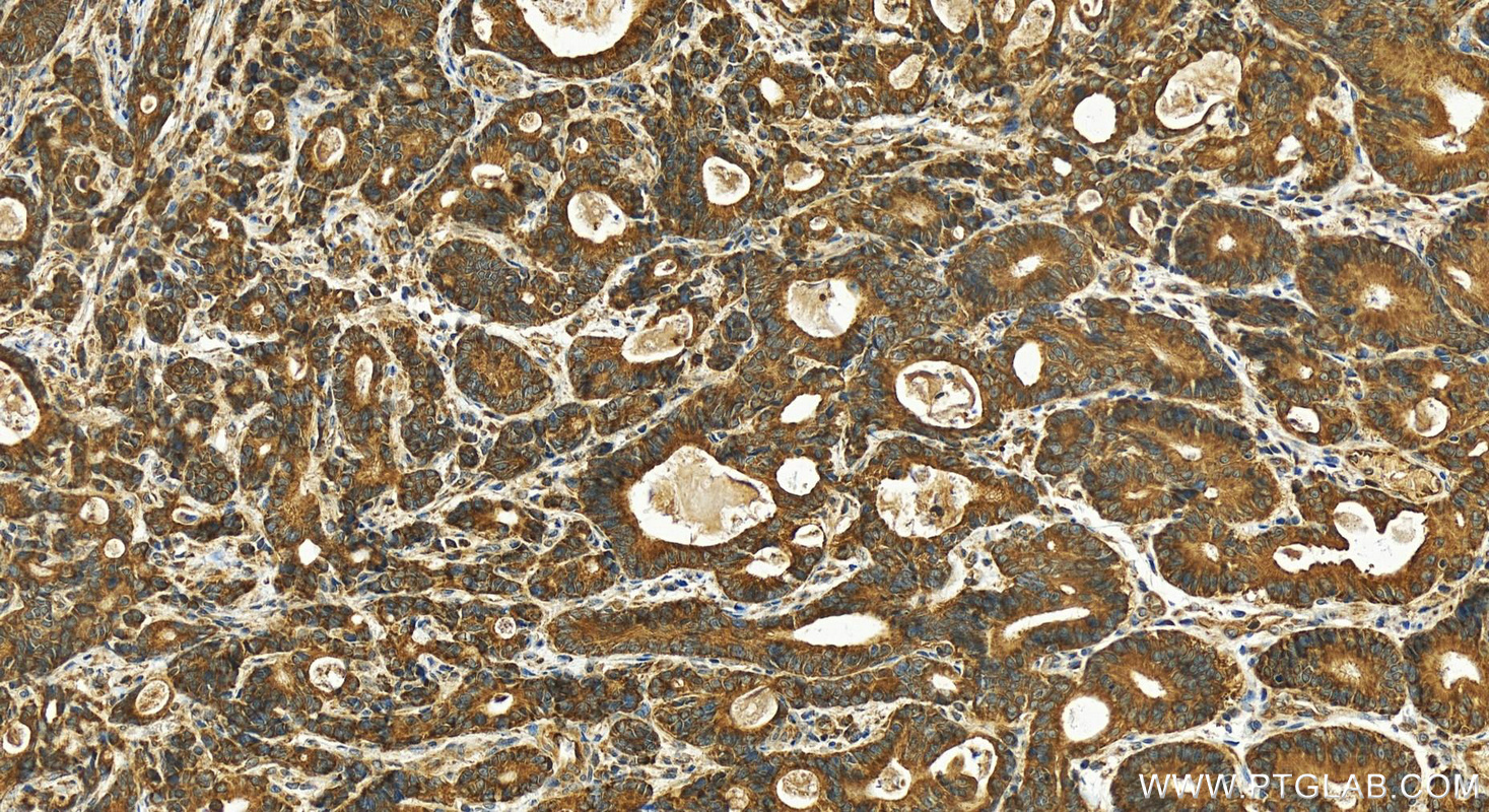 Immunohistochemistry (IHC) staining of human stomach cancer tissue using CHCHD1 Polyclonal antibody (11728-1-AP)