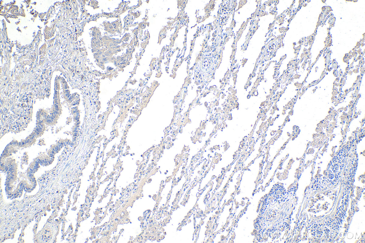 Immunohistochemistry (IHC) staining of human lung cancer tissue using CHCHD3 Monoclonal antibody (68259-1-Ig)