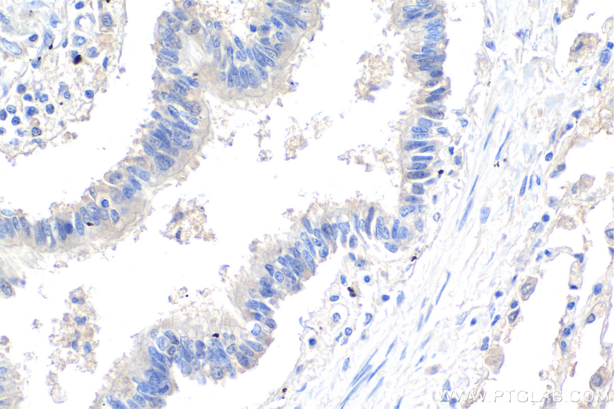 Immunohistochemistry (IHC) staining of human lung cancer tissue using CHCHD3 Monoclonal antibody (68259-1-Ig)