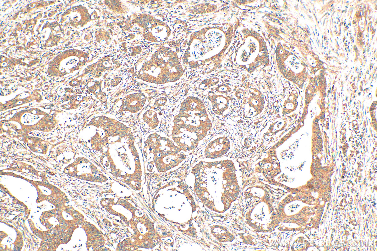 Immunohistochemistry (IHC) staining of human colon cancer tissue using CHMP7 Polyclonal antibody (16424-1-AP)