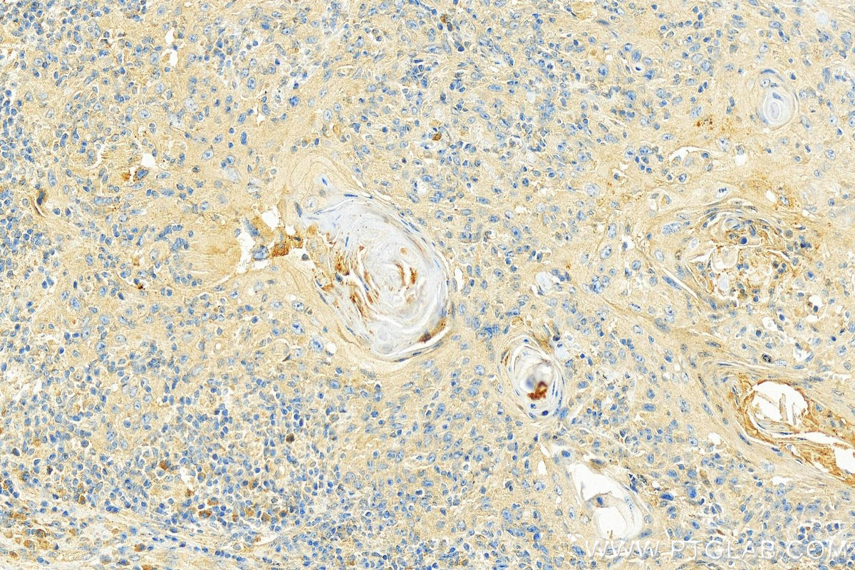 Immunohistochemistry (IHC) staining of human skin cancer tissue using CHPF-N terminal Polyclonal antibody (15801-1-AP)