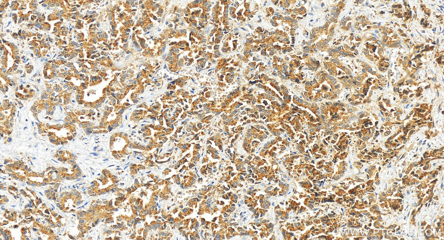 Immunohistochemistry (IHC) staining of human intrahepatic cholangiocarcinoma tissue using CHST9 Polyclonal antibody (13135-1-AP)