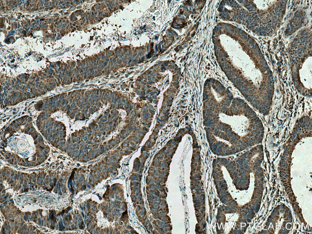 Immunohistochemistry (IHC) staining of human colon cancer tissue using CIN85 Polyclonal antibody (12132-1-AP)