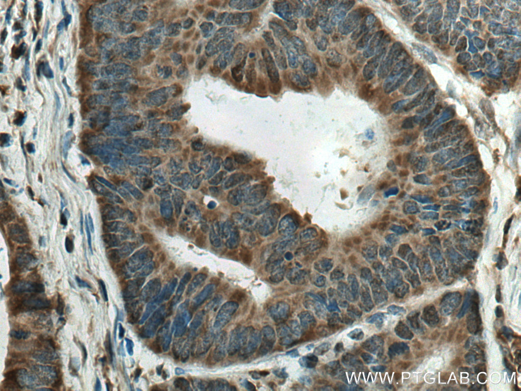 Immunohistochemistry (IHC) staining of human colon cancer tissue using CIN85 Polyclonal antibody (12132-1-AP)