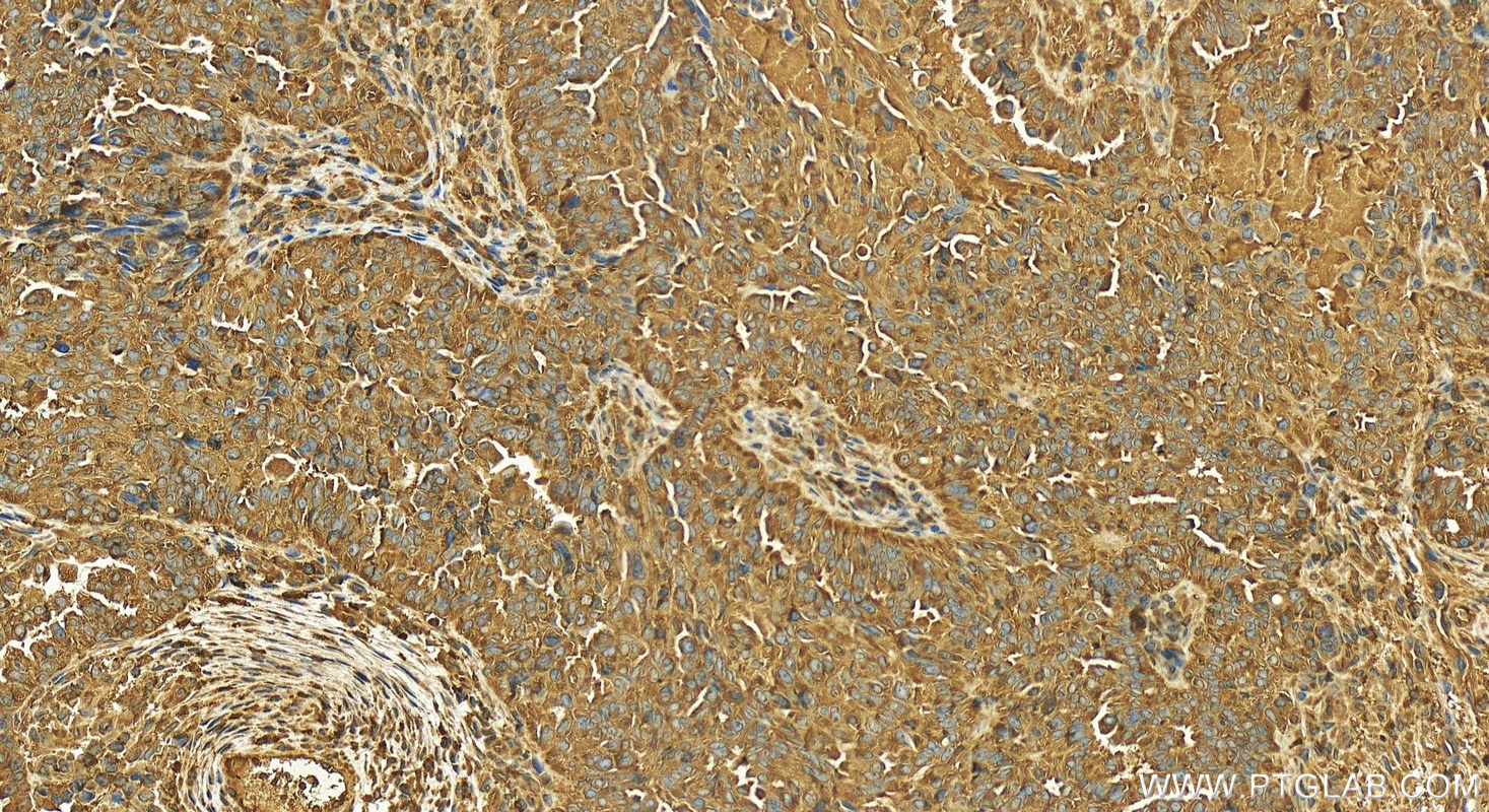 Immunohistochemistry (IHC) staining of human ovary cancer tissue using CIN85 Polyclonal antibody (12132-1-AP)