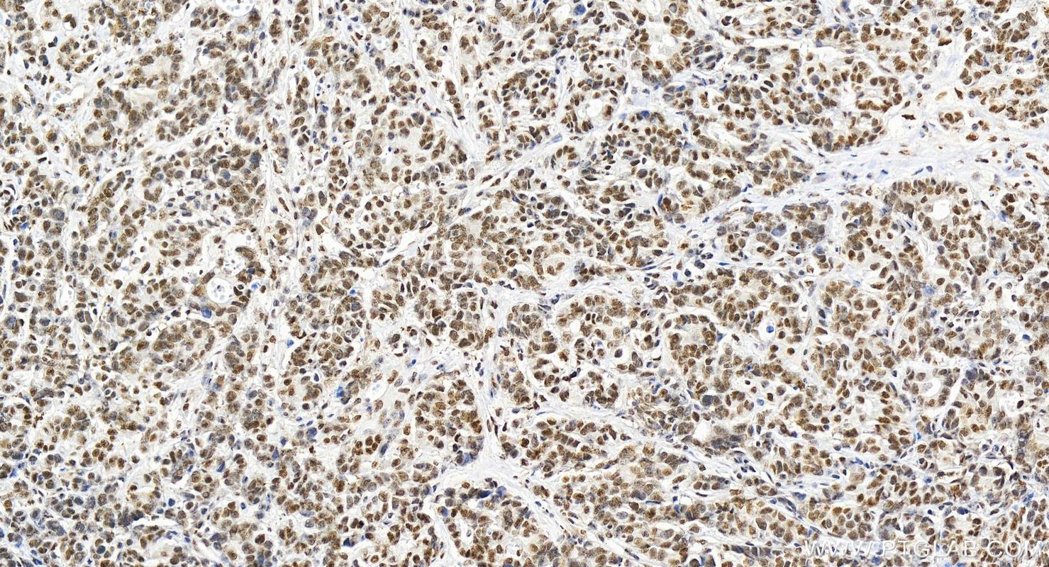 Immunohistochemistry (IHC) staining of human stomach cancer tissue using CIP29 Polyclonal antibody (15798-1-AP)