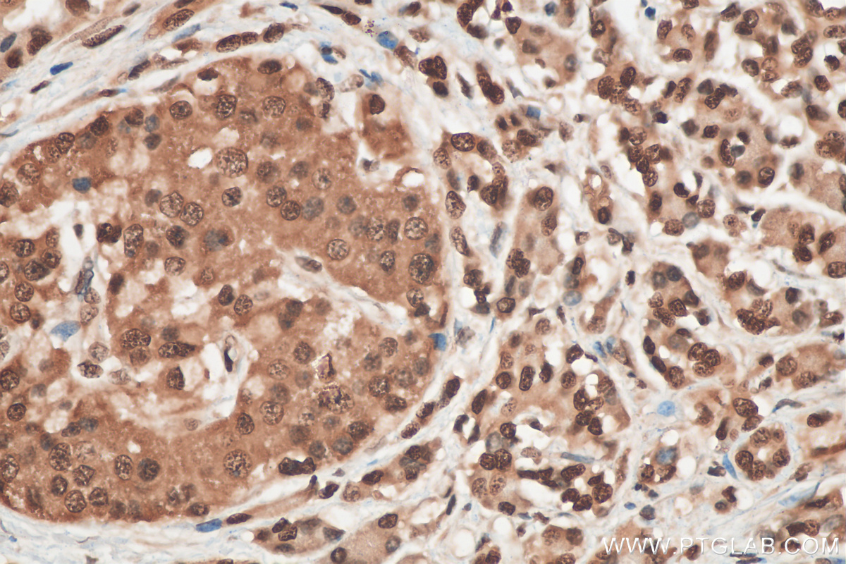 Immunohistochemistry (IHC) staining of human pancreas cancer tissue using CIRBP Polyclonal antibody (10209-2-AP)