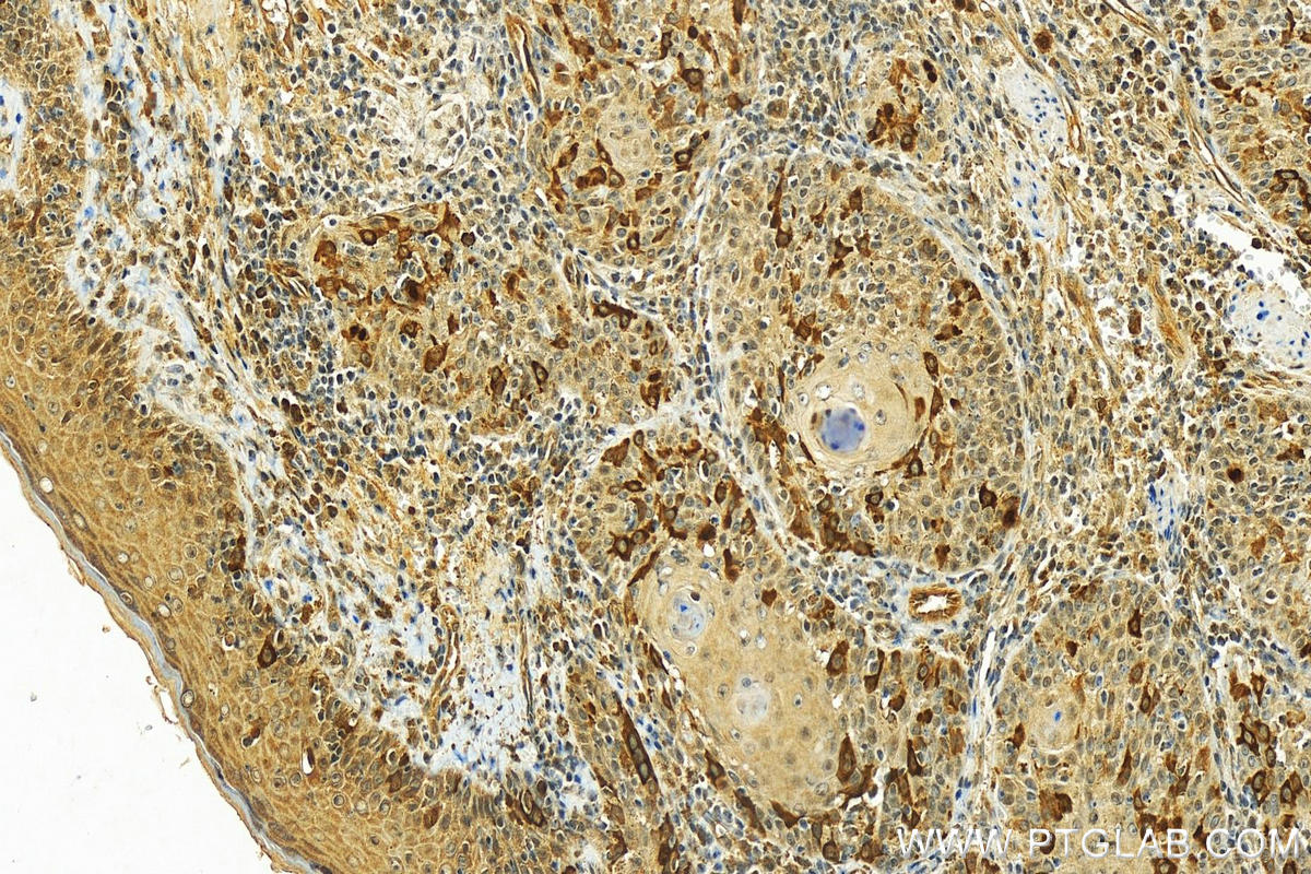 Immunohistochemistry (IHC) staining of human skin cancer tissue using CKAP2 Polyclonal antibody (25486-1-AP)