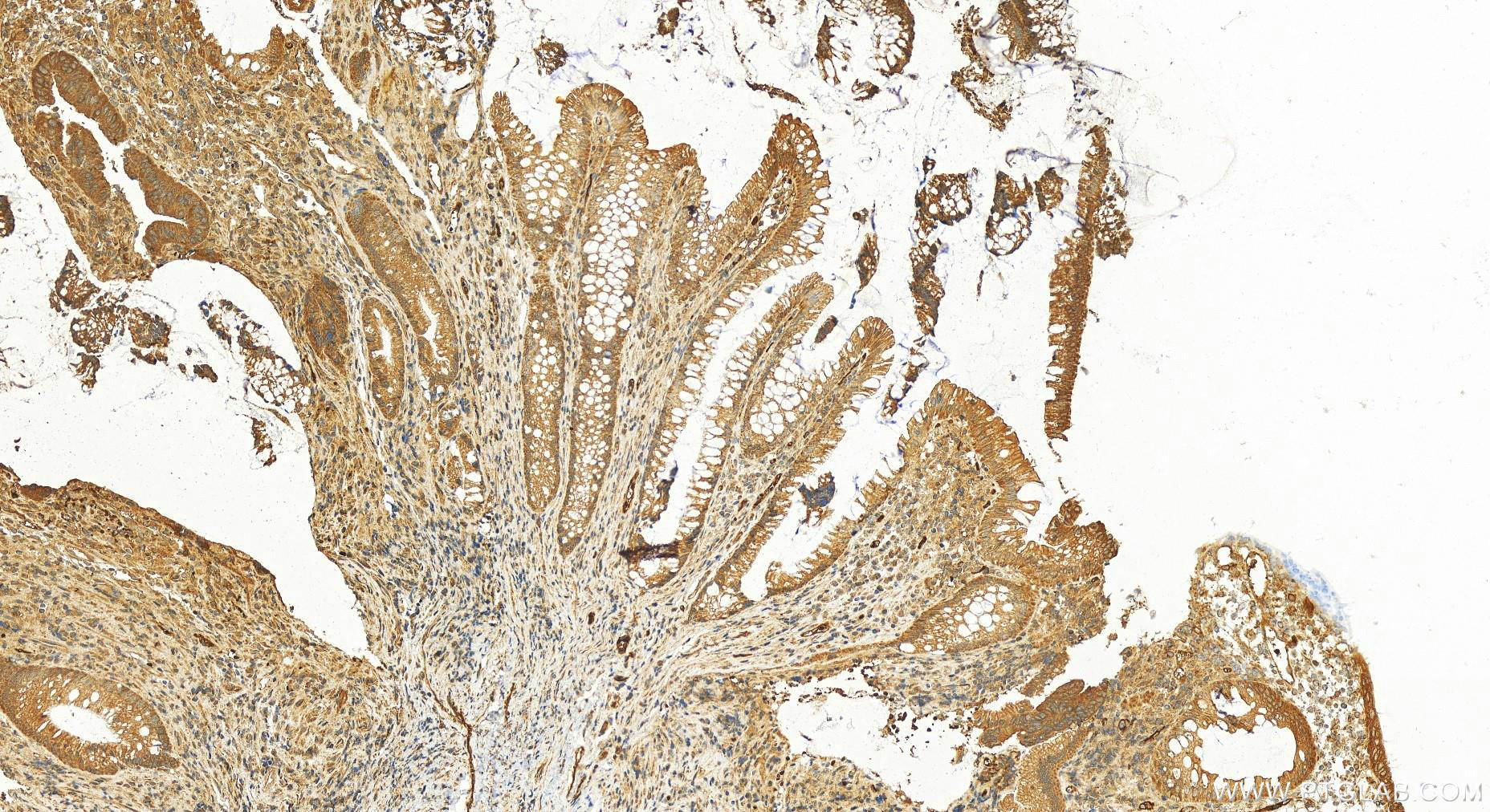 Immunohistochemistry (IHC) staining of human colon  cancer using CKAP2L Polyclonal antibody (17143-1-AP)