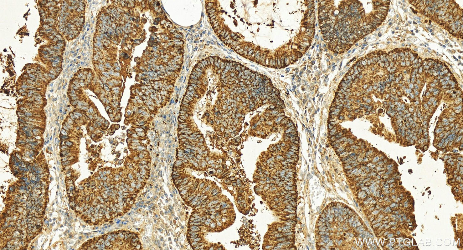 Immunohistochemistry (IHC) staining of human colon cancer tissue using CKMT1A Polyclonal antibody (15346-1-AP)