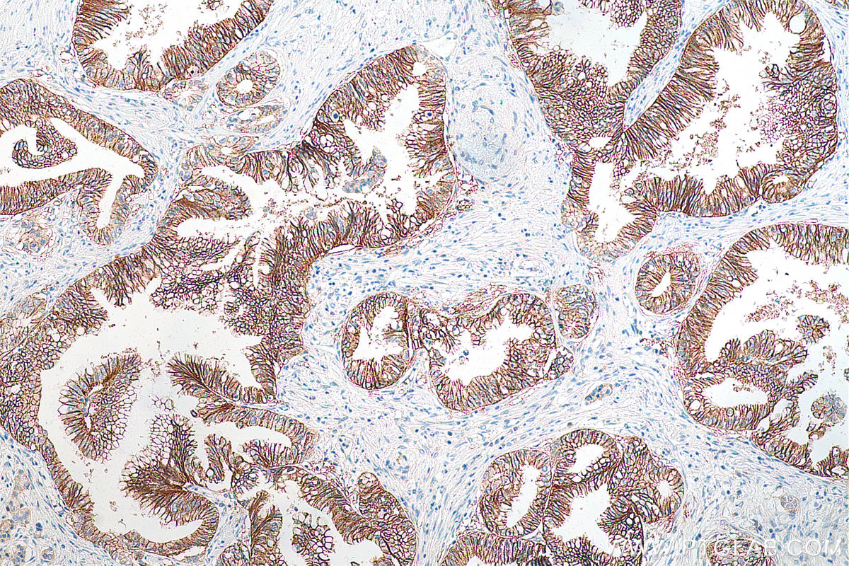 Immunohistochemistry (IHC) staining of human pancreas cancer tissue using Claudin 18 Polyclonal antibody (21126-1-AP)