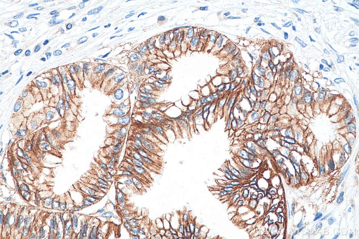 Immunohistochemistry (IHC) staining of human pancreas cancer tissue using Claudin 18 Polyclonal antibody (21126-1-AP)