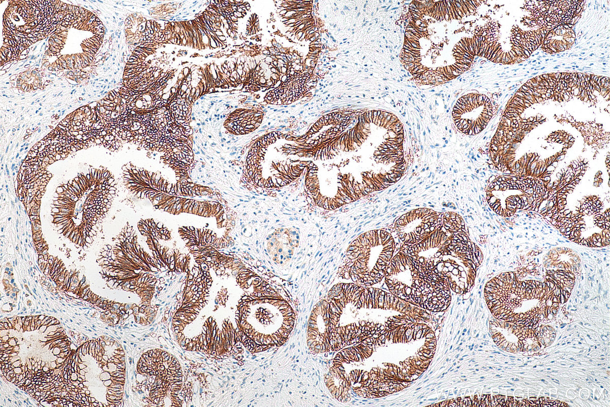 Immunohistochemistry (IHC) staining of human pancreas cancer tissue using Claudin 18 Monoclonal antibody (66167-1-Ig)