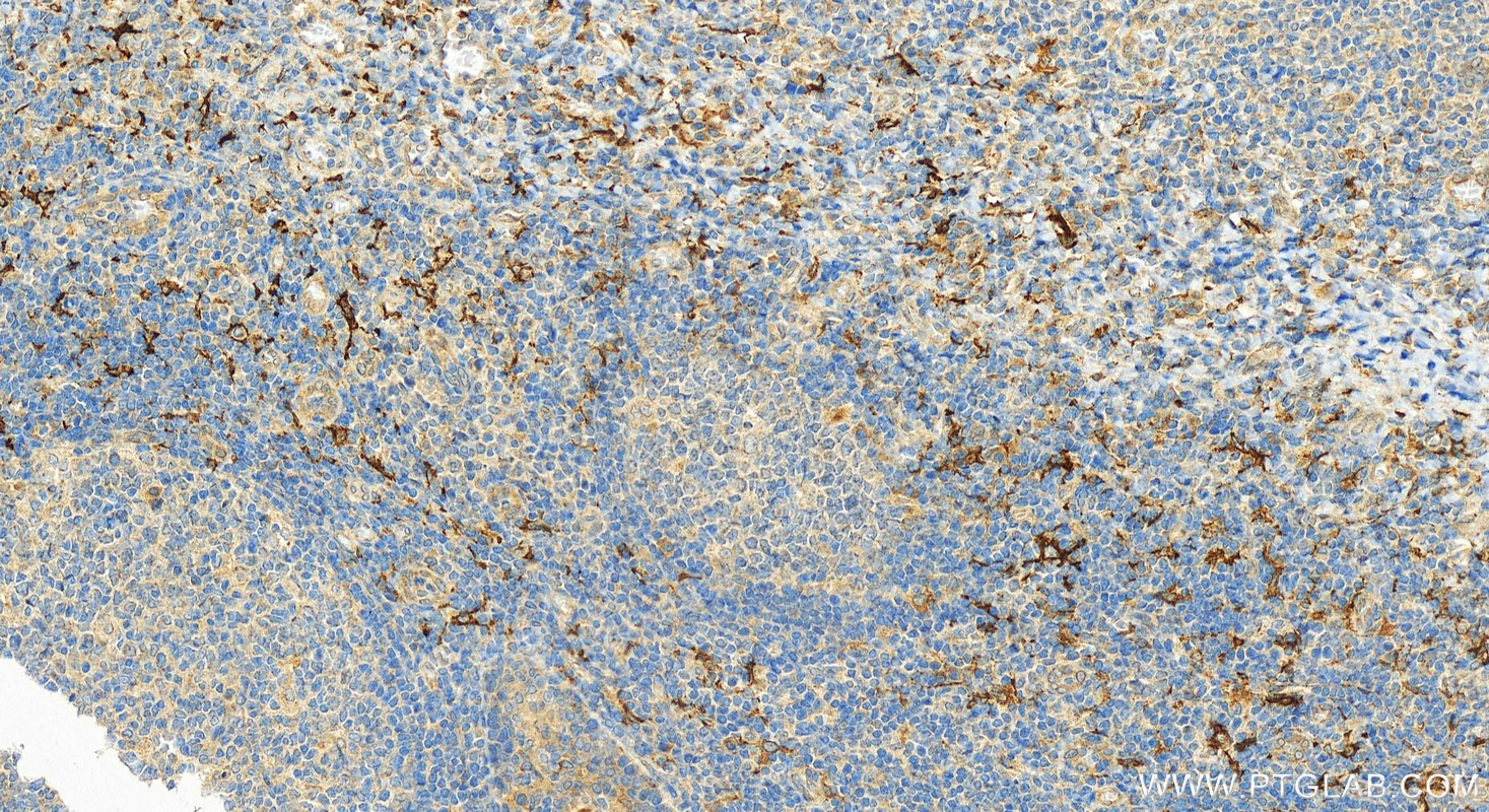 Immunohistochemistry (IHC) staining of human tonsillitis tissue using DC-SIGNR/CD299 Polyclonal antibody (22003-1-AP)